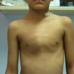 Pectus Excavatum: La deformidad Silenciosa que limita la respiración y el rendimiento físico