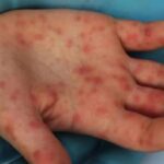 Ecuador: alerta epidemiológica por viruela símica