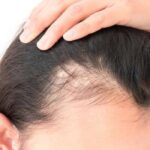 La caída de cabello después del embarazo afecta a millones de mujeres: especialistas explican por qué ocurre y cómo contrarrestarla
