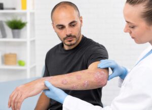 Nueva terapia biológica llega a Ecuador para ampliar las opciones de tratamiento de la psoriasis moderada a grave